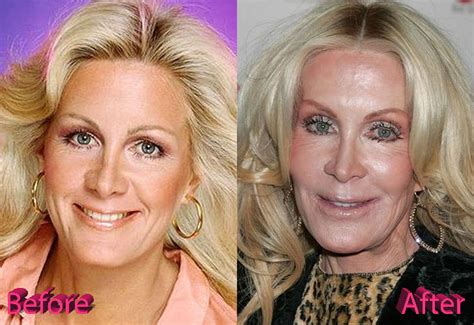 did joan van ark have plastic surgery|joan van ark face.